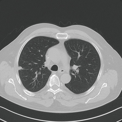 Lungenmetastase bei Z.n. Rektumkarzinom, minimalinvasive Ablation mittels...