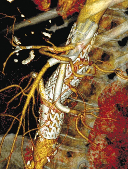 Abb. 1: Ausschaltung eines pararenalen Aneurysmas mit Revaskularisation des...