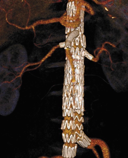 Abb. 2: Darstellung einer 3-fach fenestrierten Prothese mit einer Aussparung...