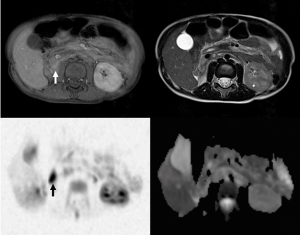 Oben: T2- (rechts) und T1-Bildgebung nach Kontrastmittelgabe (links) zeigen...