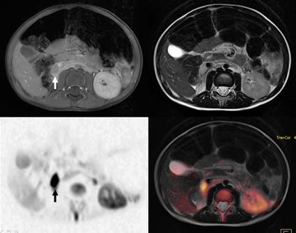 In der T2 und T1 gut abgrenzbare, malignitätsverdächtige Veränderung...