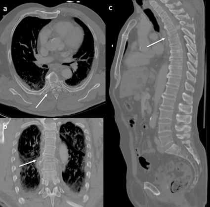 CT-Darstellung der Wirbelsäule im Rahmen eines Polytrauma-Scans. Das axiale...