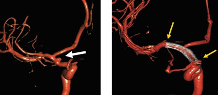 3-D-Darstellung einer gebluteten Hirngefäßaussackung (Aneurysma – weißer...