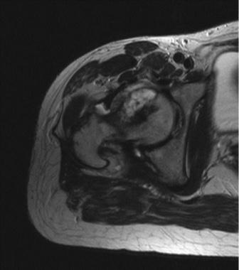 Abb. 1: MRT rechtes Hüftgelenk in T1-Wichtung, Darstellung des Tumors im...