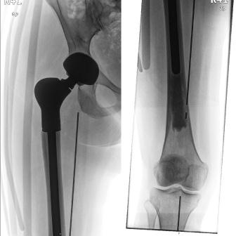Röntgen rechtes Femur a.p., Versorgung mit zementfreiem Pfannensockel...