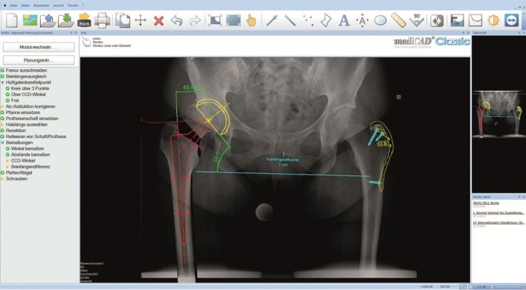 mediCAD 2.52 ist in Kürze in der Uni Balgrist verfügbar. Neue...