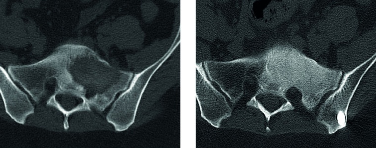 Abb. 3c: Ausgedehnte osteolytische Metastase eines Mammakarzinoms im Bereich...