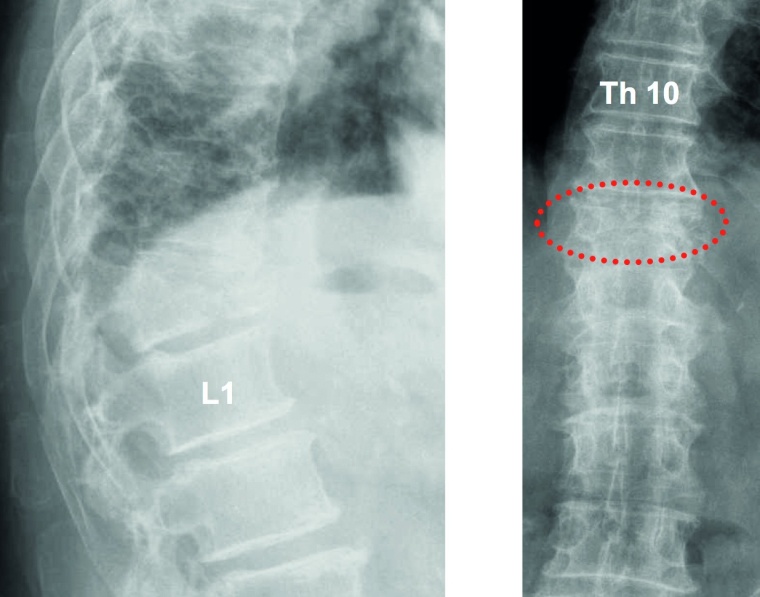Abb. 1a: Palliative Versorgung einer pathologisch frakturierten...