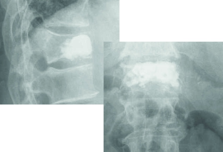 Abb. 1b: Palliative Versorgung einer pathologisch frakturierten...