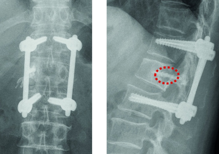Abb. 2: Rezidiv bei bekanntem Mammakarzinom mit zunehmenden Schmerzen bei...