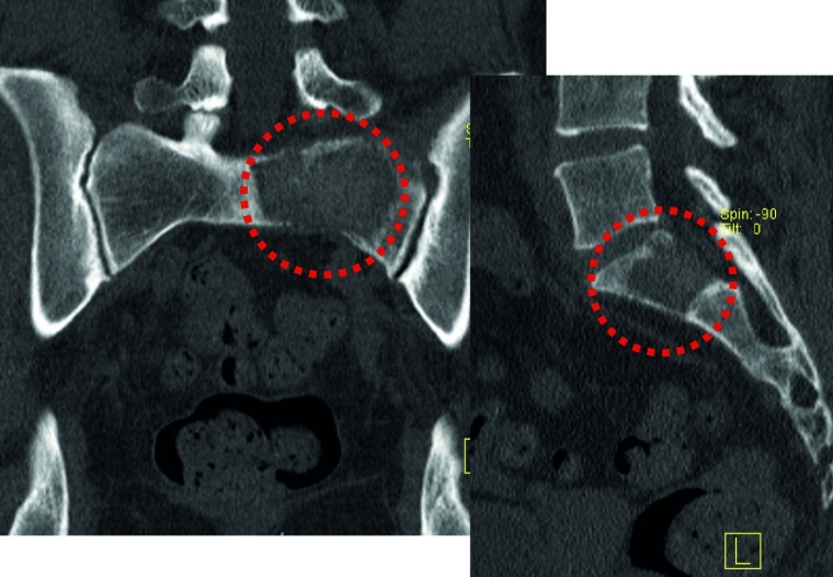 Abb. 3a: Ausgedehnte osteolytische Metastase eines Mammakarzinoms im Bereich...
