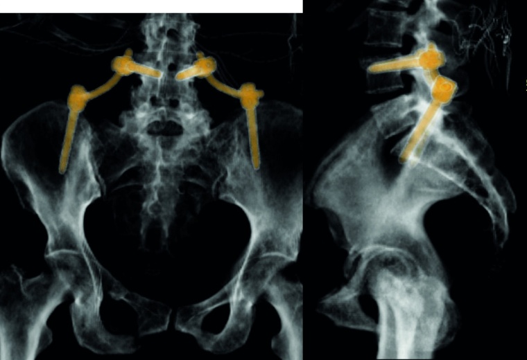 Abb. 3b: Ausgedehnte osteolytische Metastase eines Mammakarzinoms im Bereich...
