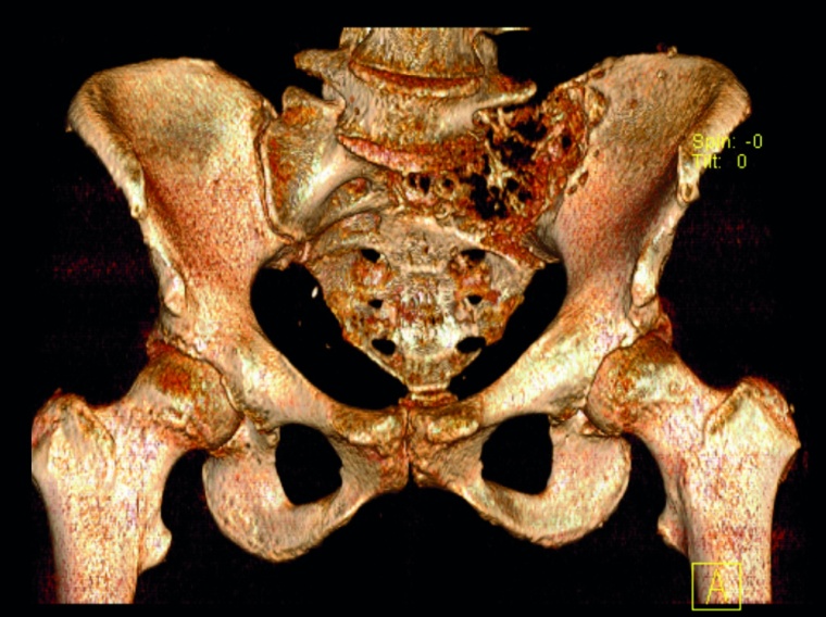 Abb. 4a: Osteolytische Metastase eines Mammakarzinoms mit pathologischer...