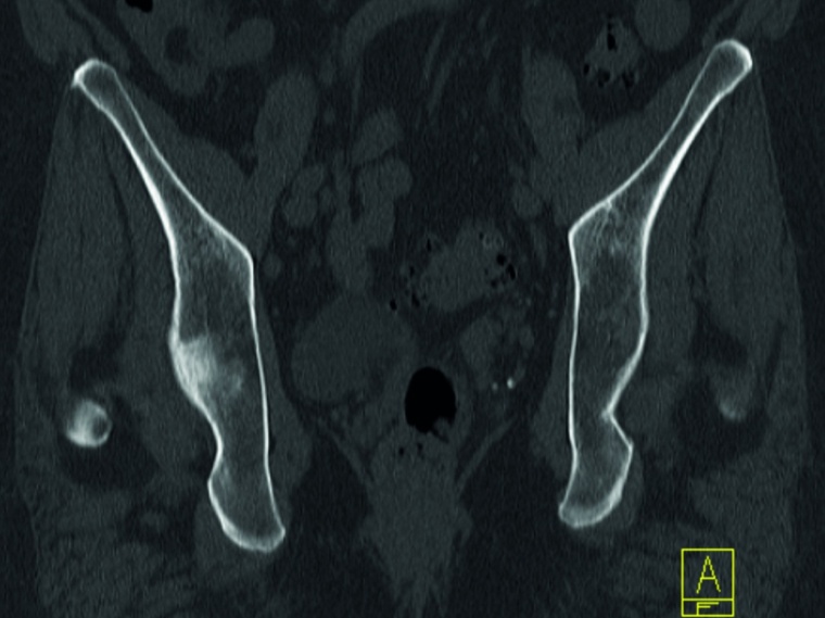 Abb. 4b: CT-Rekonstruktion des Beckenkamms ventral der vom Sakrum ausgedehnt...