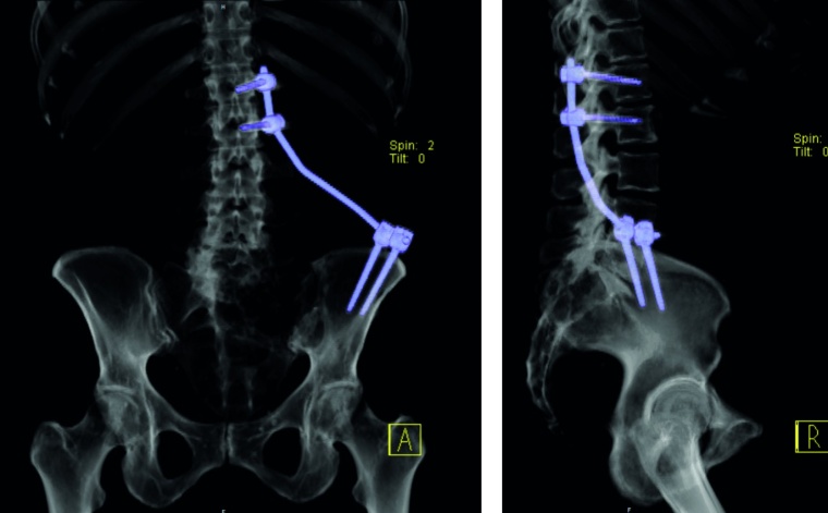 Abb. 4c: Postoperatives Ergebnis mit modifizierter vertebropelviner Abstützung....