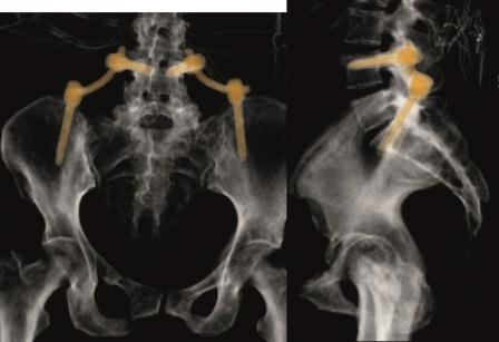 Photo: Palliative Versorgung von Metastasen an Wirbelsäule und Becken