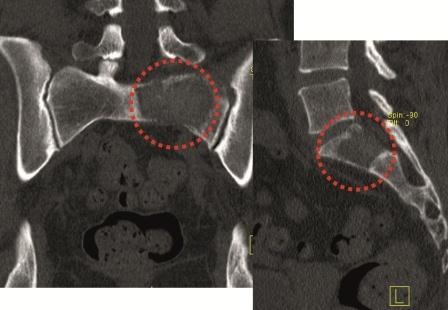 Photo: Palliative Versorgung von Metastasen an Wirbelsäule und Becken
