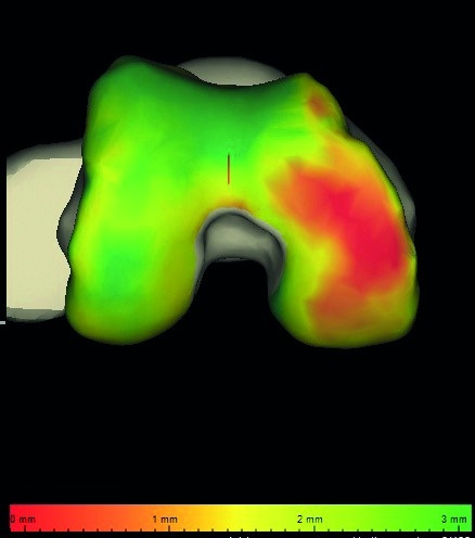 Abb. 2a: Das „Knorpelmapping“ (Zimmer) zeigt die anhand des MRT ermittelte...