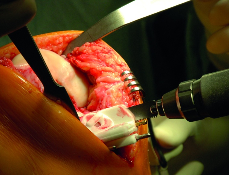 Abb. 3c: Das Bild einer Säge-Schablone für die Tibia-Komponente einer...