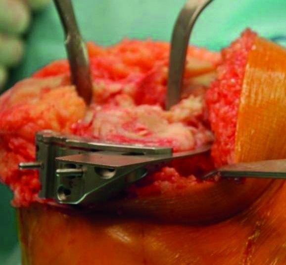 Abb. 3b: Über die Pins wird dann der Tibiasägeblock angelegt