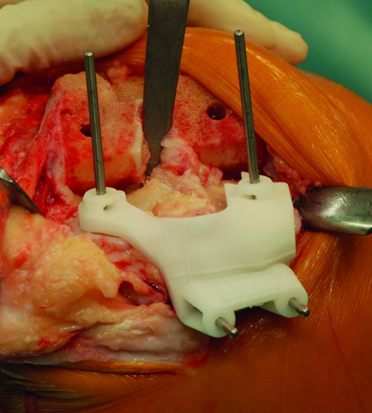 Abb. 3a, b, c: Intraoperatives Bild einer Pin-Schablone für die Tibia (a)....