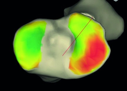 Abb. 2b: Das „Knorpelmapping“ (Zimmer) zeigt die anhand des MRT ermittelte...