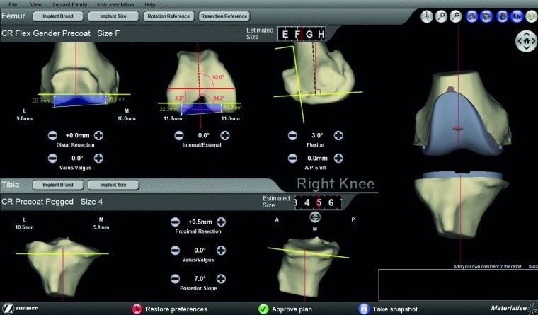 Abb. 1: Beispiel für eine präoperative Planung. Die Planungssoftware dieses...