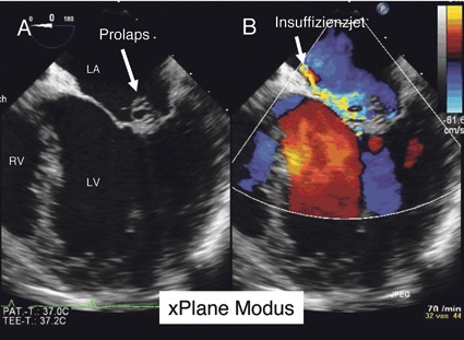 Abb. 1: 2-D-transösophageale Echokardiografie (LA, linker Vorhof; LV, linker...