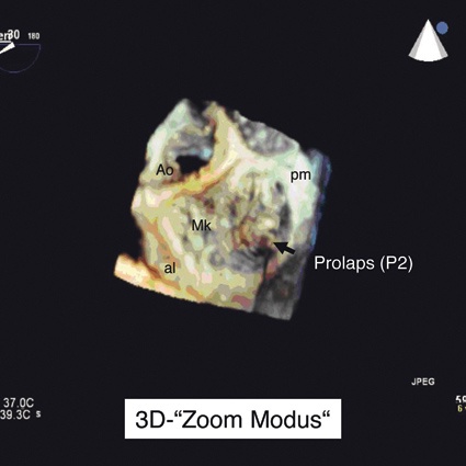 Abb. 2: 3-D-transösophageale Echokardiografie (Ao, Aortenklappe; Mk,...