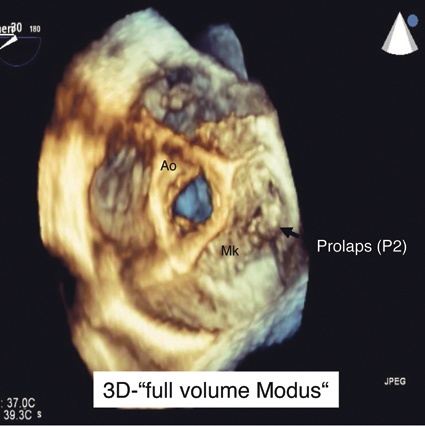 Abb. 3: 3-D-TEE Darstellung der Mitralklappe zum Zeitpunkt der Systole (Ao,...