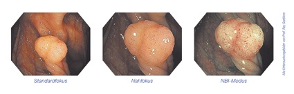 Von links nach rechts: Standardfokus-, Nahfokus-, NBI-Modus-Bilder (Prof. Roy...