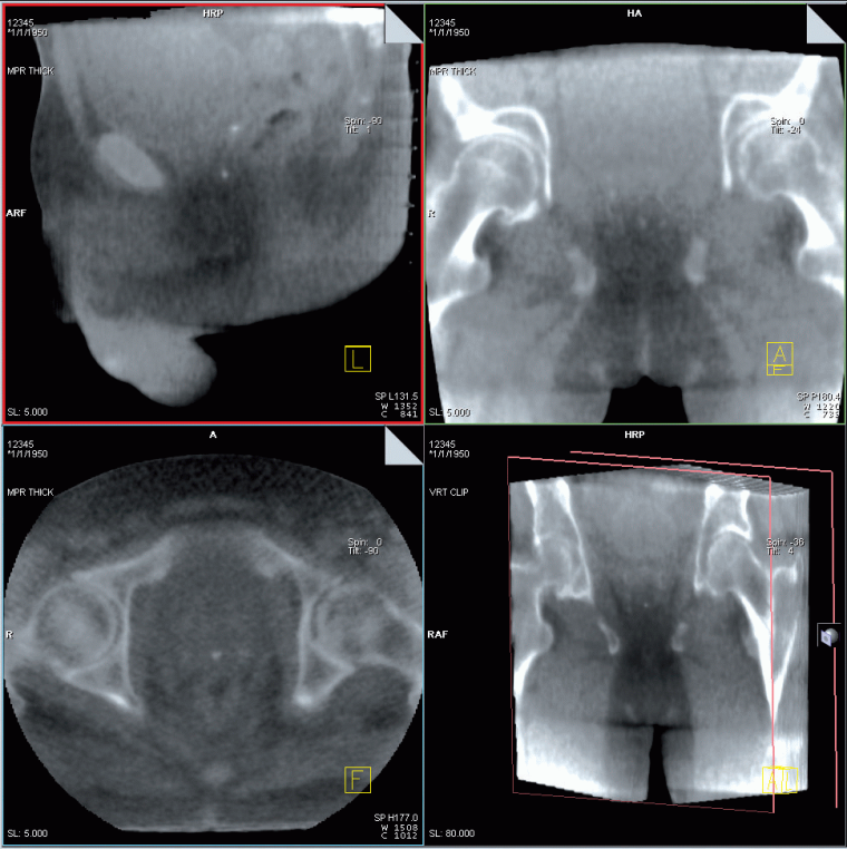 Abb. 1: MV Core Beam Imaging Pelvis (UCSF San Francisco)