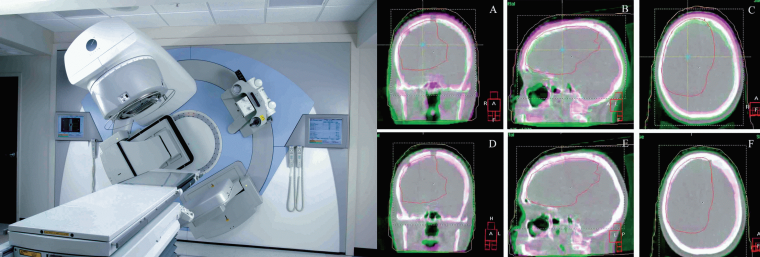 (links) Abb. 1: Linearbeschleuniger mit gantrymontiertem Cone-beam CT (Elekta...