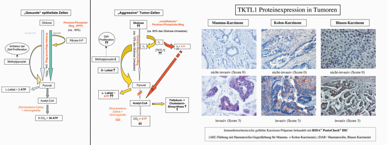 (oben) Zuckerstoffwechsel der Zellen (unten) TKTL1 Proteinexpression in...