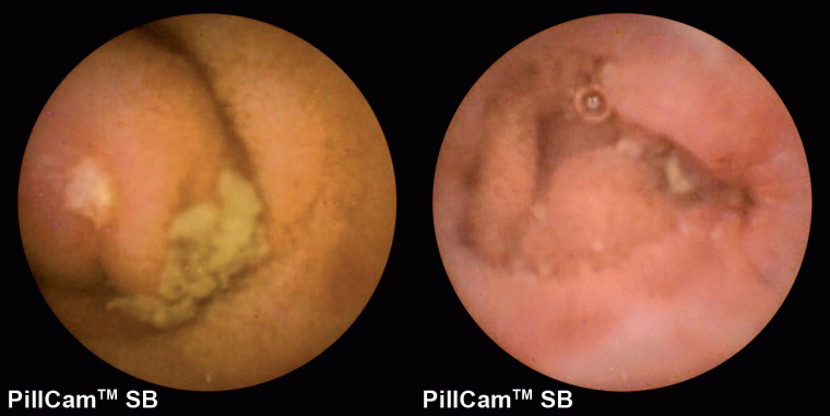 NSAR-induzierte Schäden im Dünndarm