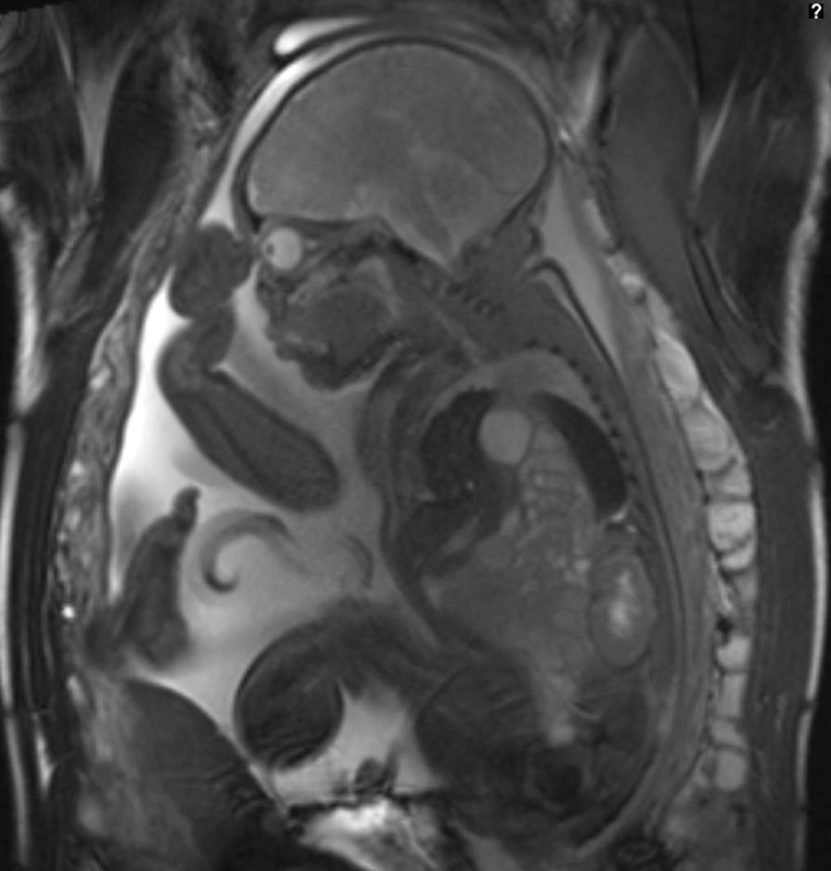 Zwerchfellhernie: Fetale MRT-Untersuchung bei einem Kind mit linksseitiger...