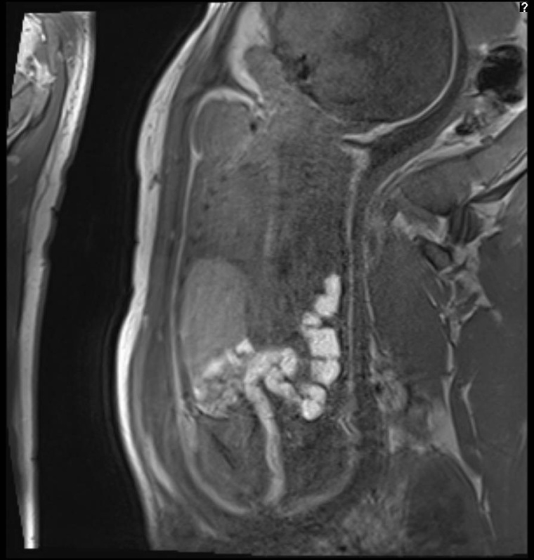 Zwerchfellhernie: Fetale MRT-Untersuchung bei einem Kind mit linksseitiger...