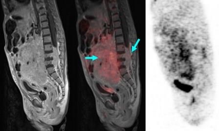 PET-MRT bei einem zwei Jahre alten Knaben mit großem abdominellen...