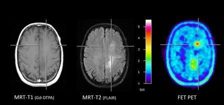 Abb. 1: Identifikation eines optimalen Biopsieortes mittels FET PET bei einer...