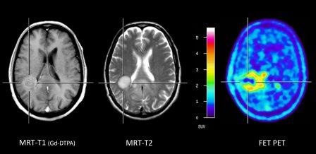 Abb. 2: Verbesserte Darstellung der Tumorausdehnung in der FET PET