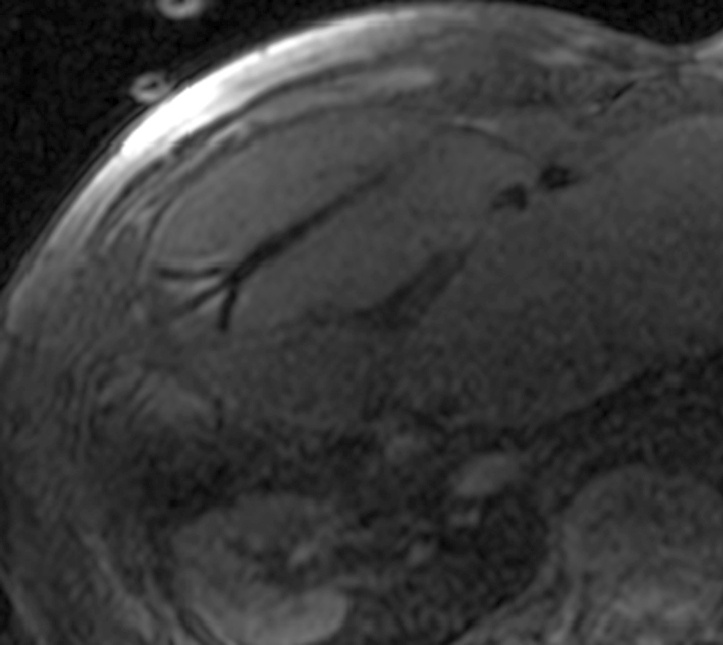 MRT-Kontrollaufnahme bestätigt die korrekte Lage der ausgefahrenen...