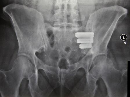 Abb. 1: Parallele Verbindung des Kreuzbeins und des Darmbeins mittels der...