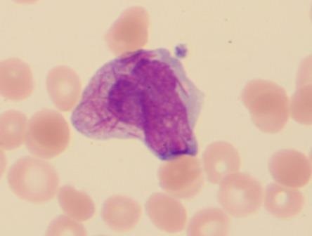 Abb. 3: Blast mit multiplen Auerstäbchen (Fagottzelle) bei...