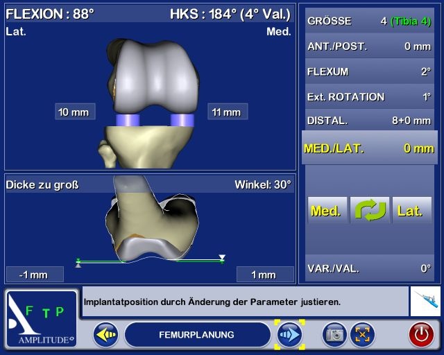 Abb. 3a: Femurplanung in Extension und Flexion