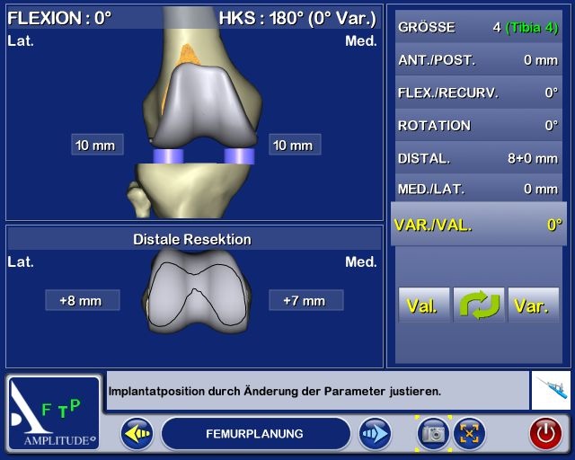 Abb. 3b: Femurplanung in Extension und Flexion