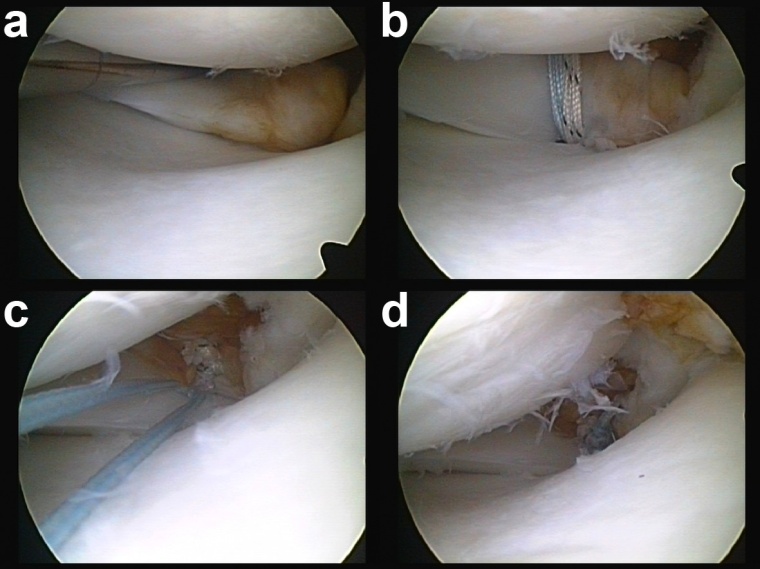 Abb. 3: Refixation der Innenmeniskus-Hinterhornwurzel mit einem Fadenanker...