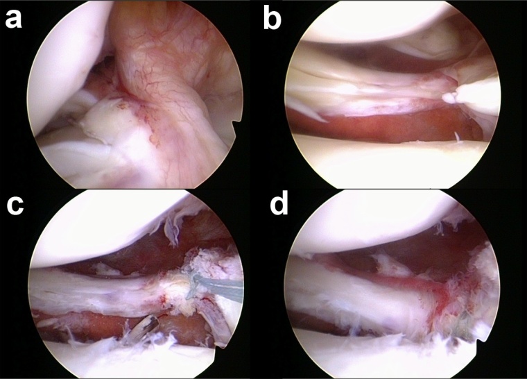 Abb. 2: Refixation der Außenmeniskus-Hinterhornwurzel mittels transtibialer...