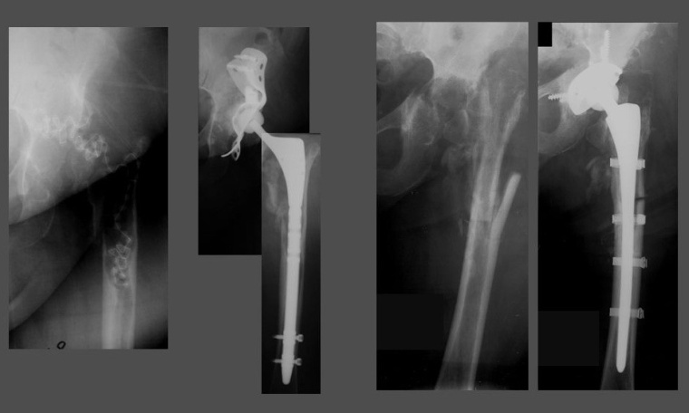 Abb. 5: Auch schwere Defekte können mit modularen Revisionsschäften versorgt...