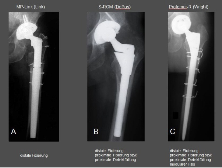 Abb. 3: Beispiele für die drei modularen Schafttypen: Schaftimplantat mit...