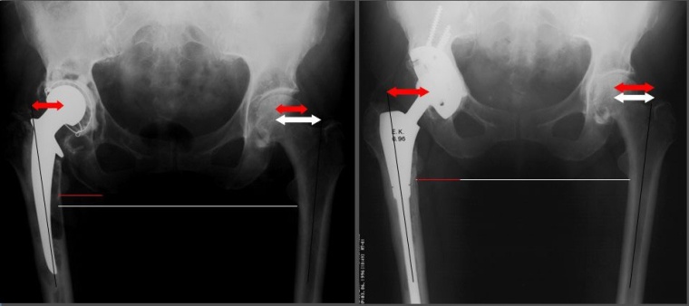 Abb. 4: Die Röntgenbilder zeigen die Korrektur von Offset und Beinlänge mit...